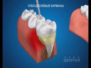 removal of tartar and plaque