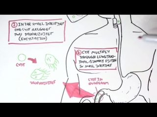 giardiasis - giardia lamblia