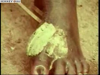 the entire tribe suffers from dracunculiasis (worms under the skin)